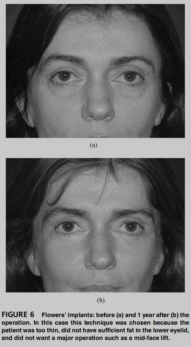 印第安纹解剖学,印第安纹分型对策