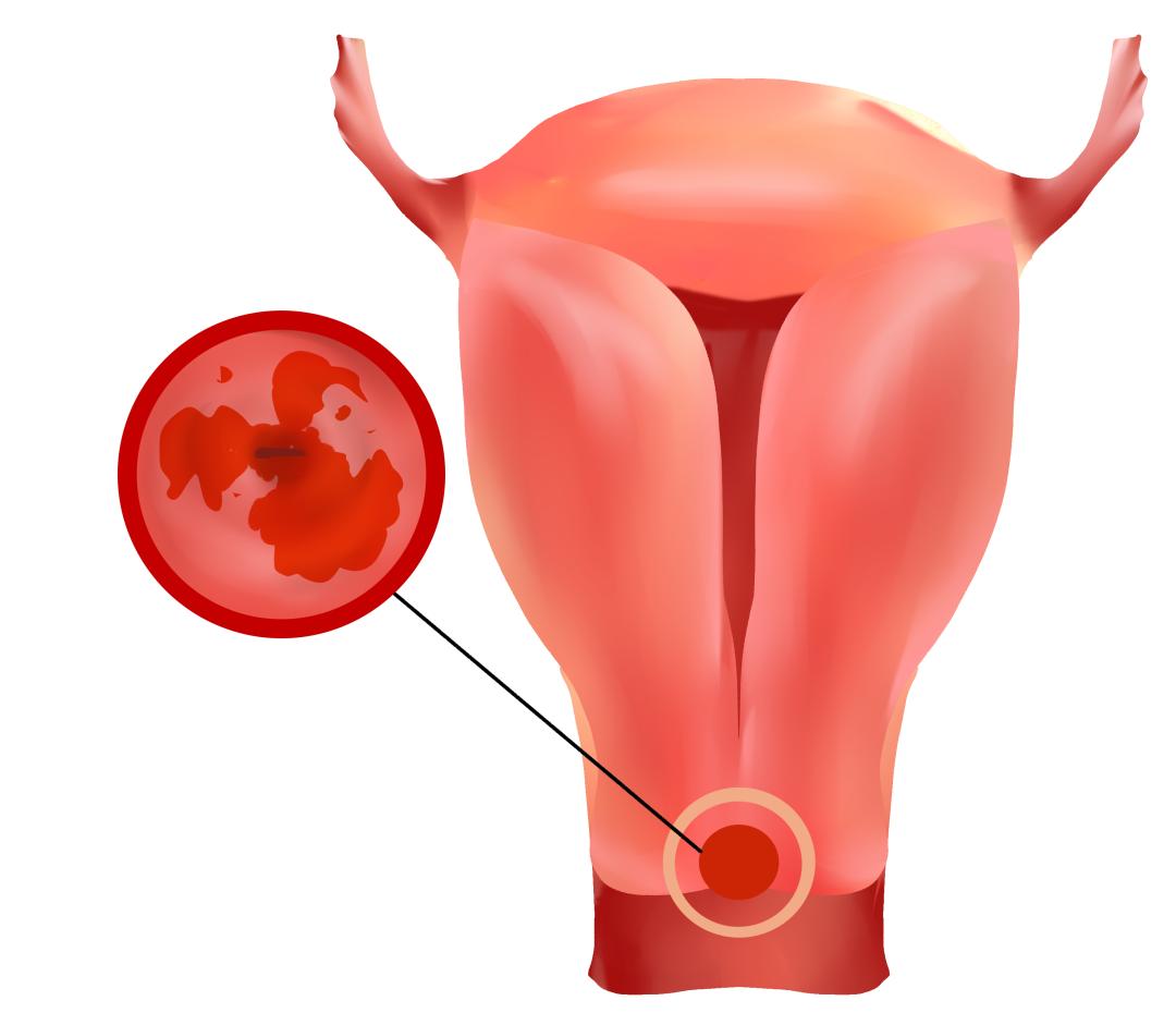 感染HPV有哪些表现？姑娘们，千万别忽视TA
