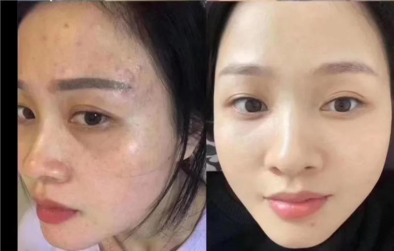 产后脸上有斑用什么药,产后脸上斑怎么快速消除