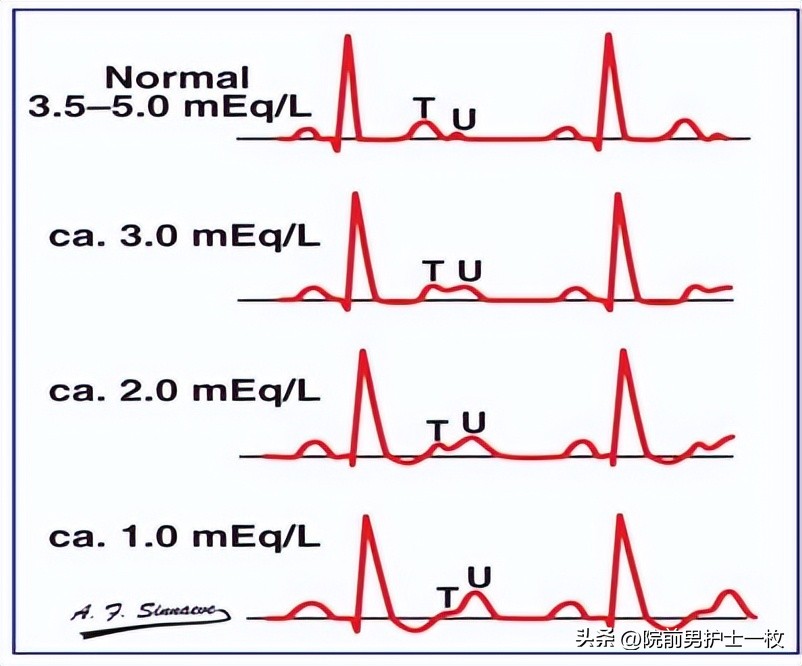 低钾性周期性麻痹怎么补钾,低钾老人吃哪些食物可以补钾啊
