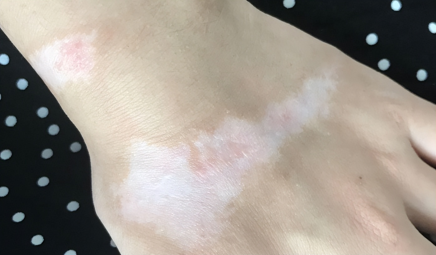 烧烫伤疤痕与硬损伤性疤痕的区别,烫伤疤痕好了可以用芦荟祛疤痕吗