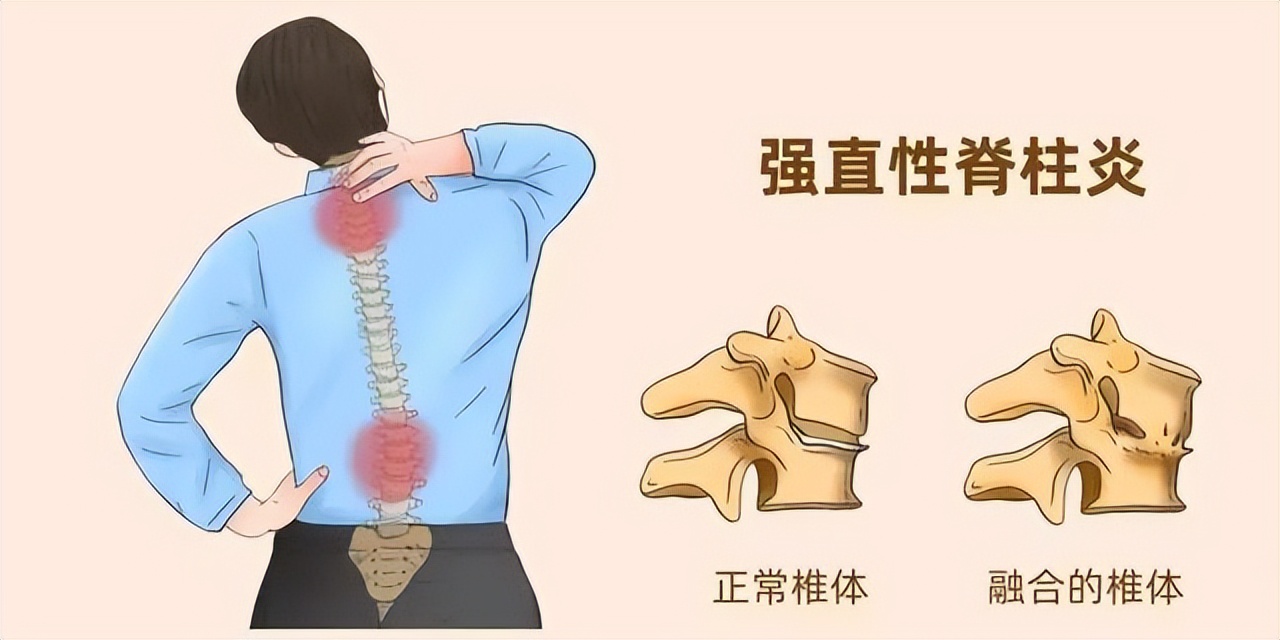 治疗强直性脊柱炎必须按体质治吗,针对强直性脊柱炎最好的锻炼方法