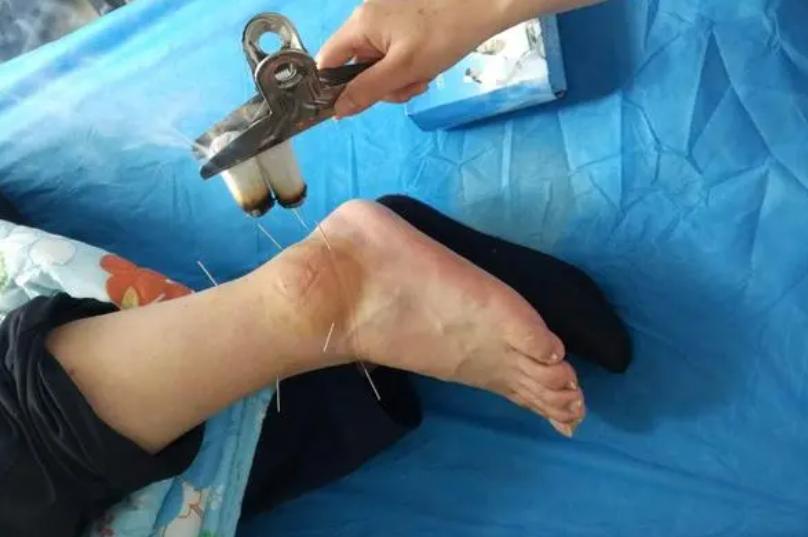 踝关节损伤针灸可以治好吗,距骨软骨损伤可以针灸吗