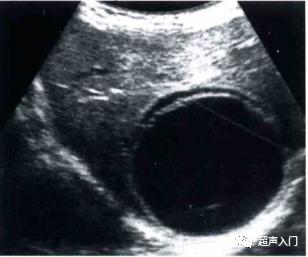 肝包虫病b超能检查出来吗,肝纤维化b超能检查出来吗