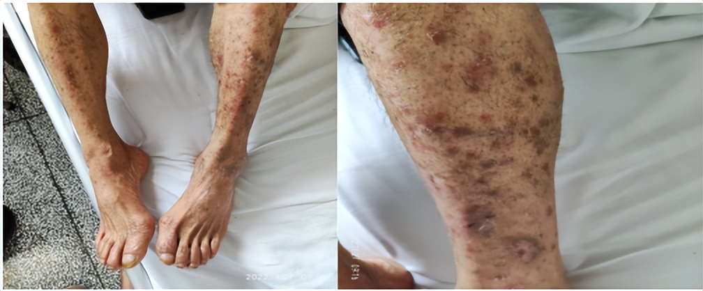 梅毒性肝炎吃什么药好,梅毒性肝炎的类型