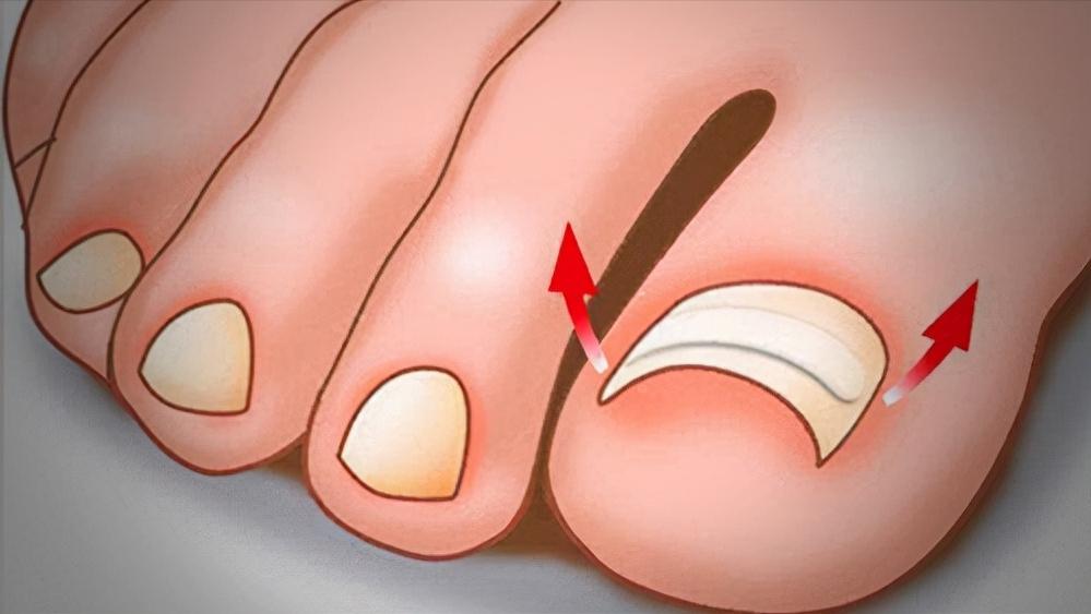 甲沟炎痛的无法剪指甲怎么办,甲沟炎清理过了为什么还是痛