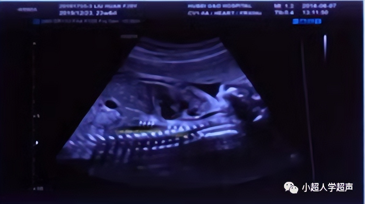 食道闭锁超声表现,食管闭锁一型手术过程