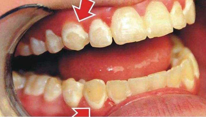 牙齿矫正期间如何让牙齿不变黄,牙齿做完矫正之后变黄了怎么办