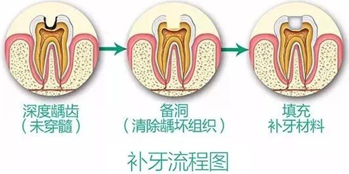 不补牙齿后牙齿会怎样,不补牙齿有问题吗