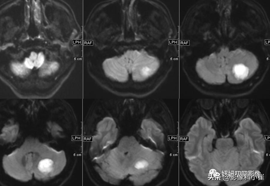 脑部局灶性强化是什么意思,脑部环形强化灶是什么意思