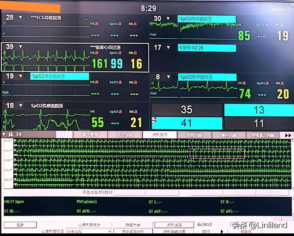 过速性房颤治疗,持续性房颤心动过速