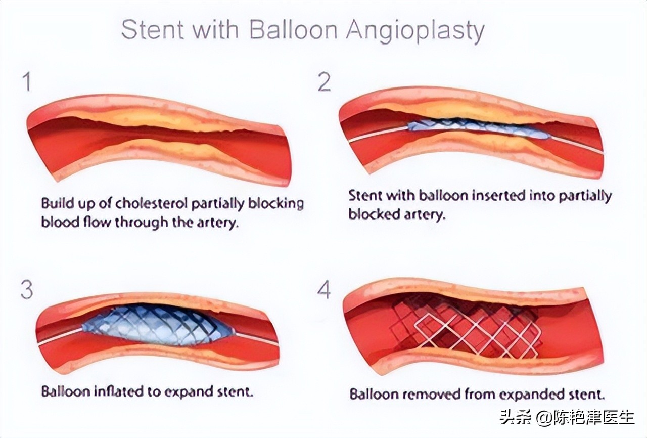 做完冠脉造影身体会虚弱吗,做完冠脉造影容易得癌症吗