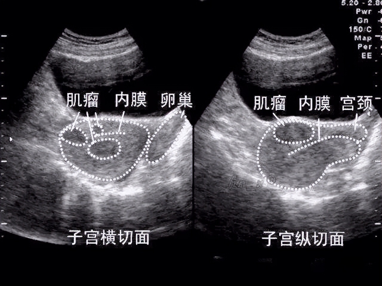 有子宫肌瘤,究竟能不能怀孕?孕期肌瘤会变大吗?