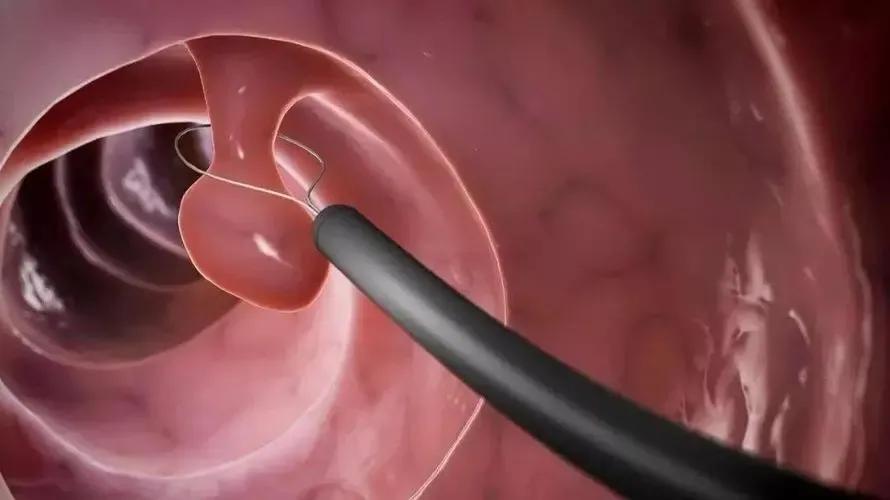 肠长了息肉会有啥症状,肠内为什么容易长息肉