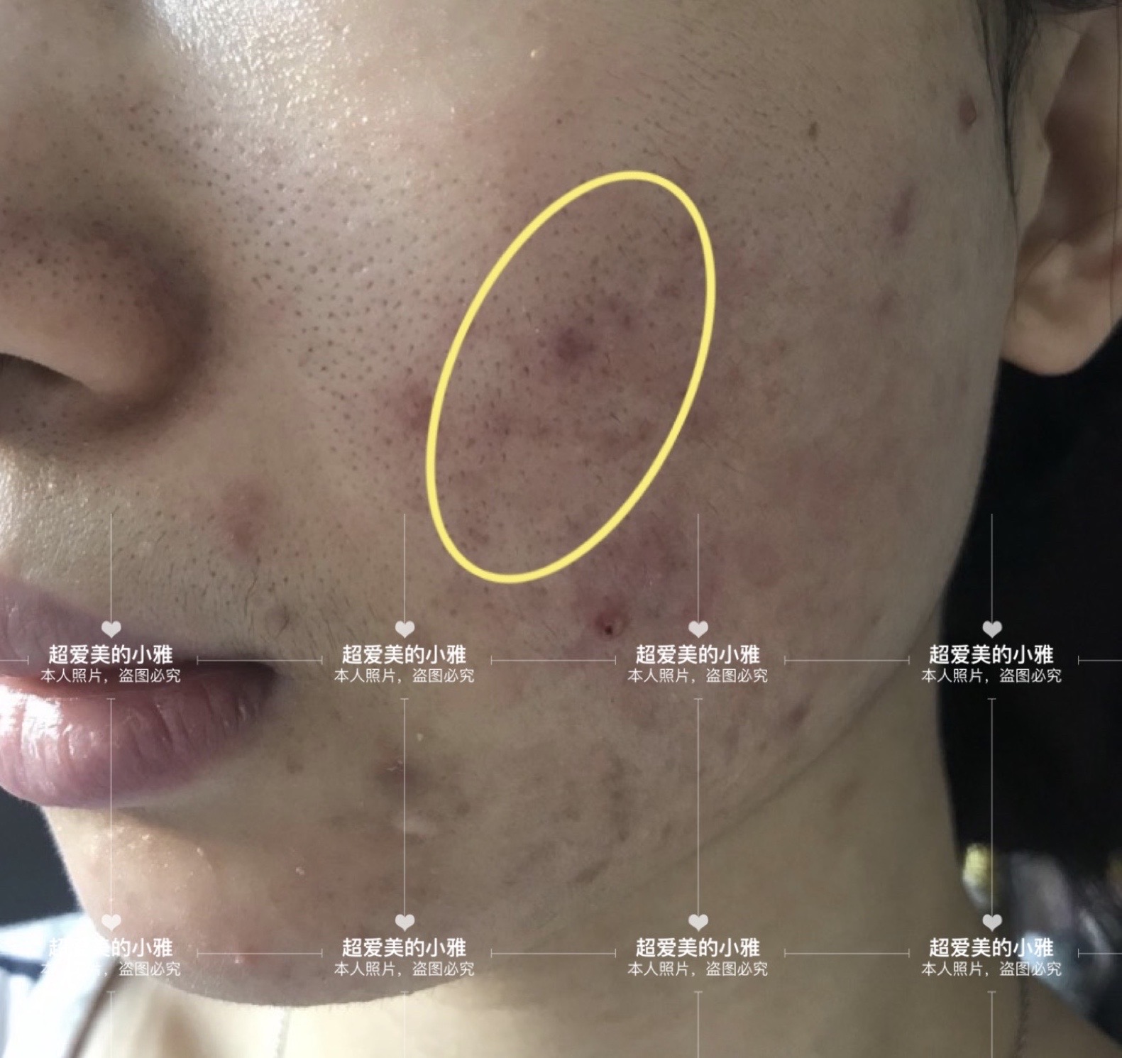 ​战胜痘痘|祛痘的加速器—针清（上）