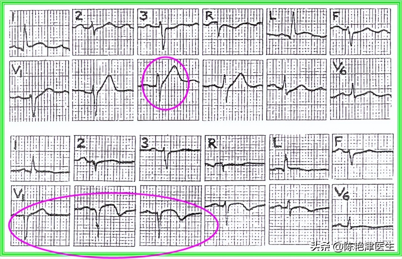 心梗前6个小时能查出什么病,心梗发作前5个部位最先发出警报