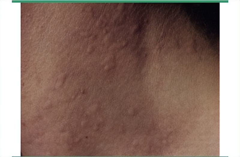 打球身上痒是什么原因,运动后皮肤瘙痒的原因有哪些