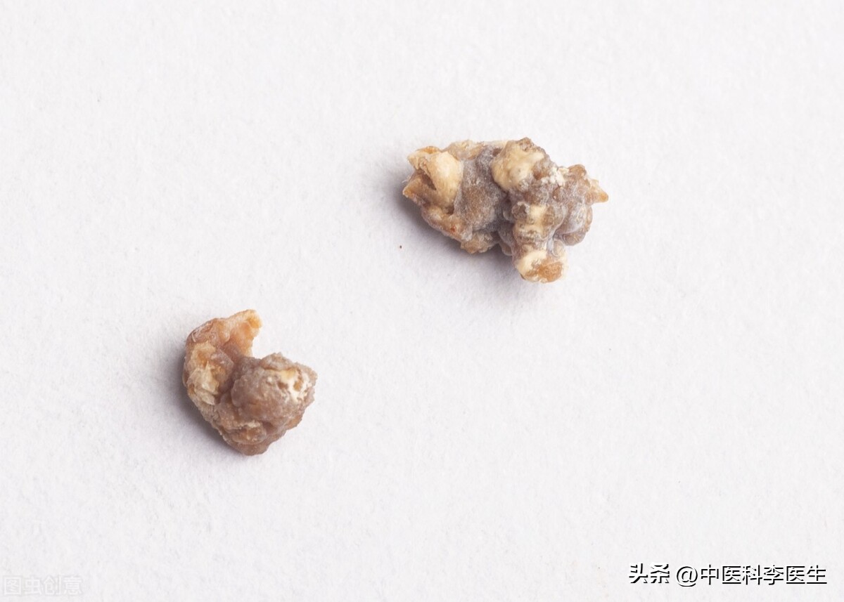 结石，6味中药兵分三路，一路利水，一路止痛，一路消石