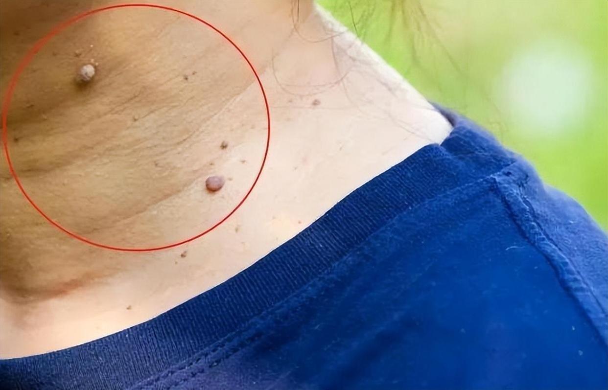 脖子上和腋下的小肉粒用什么药膏,如何让脖子上的小肉粒自然脱落