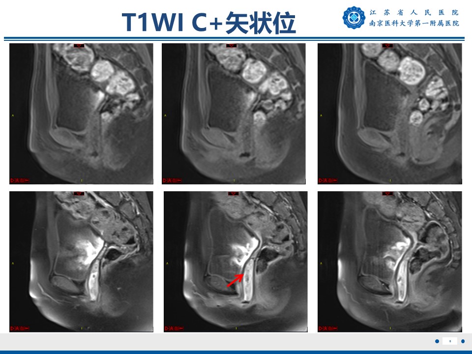 好文分享——《胚胎型横纹肌肉瘤》