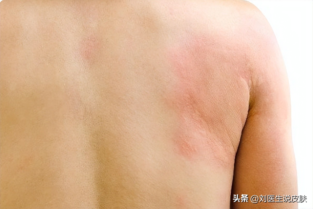 秋天皮肤干燥痒用什么润肤,夏天皮肤干痒用什么护肤