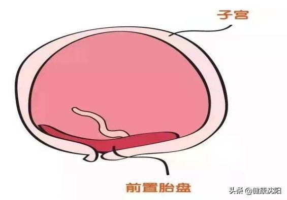 孕妇凶险性前置胎盘怎么办,前置胎盘是妊娠并发症吗