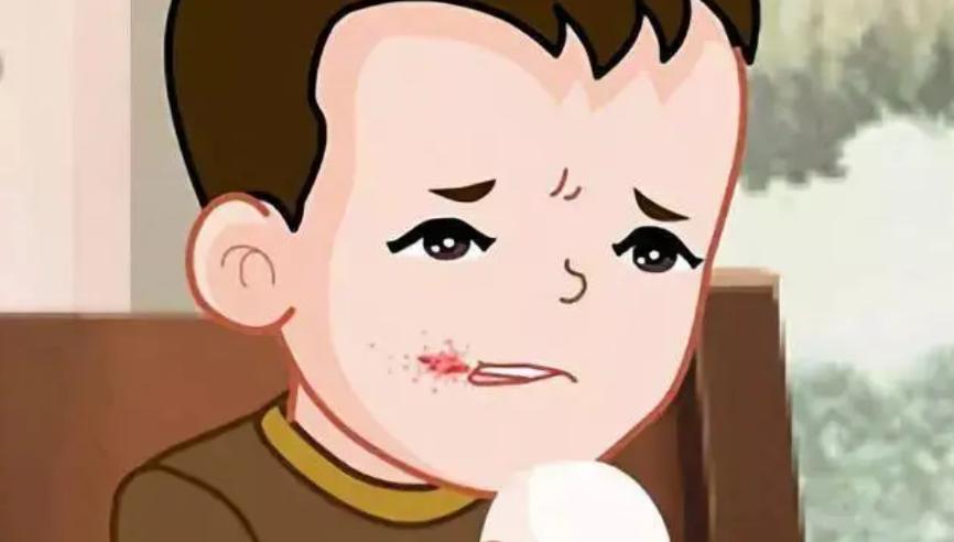 中医治烂嘴角,烂嘴角吃啥药