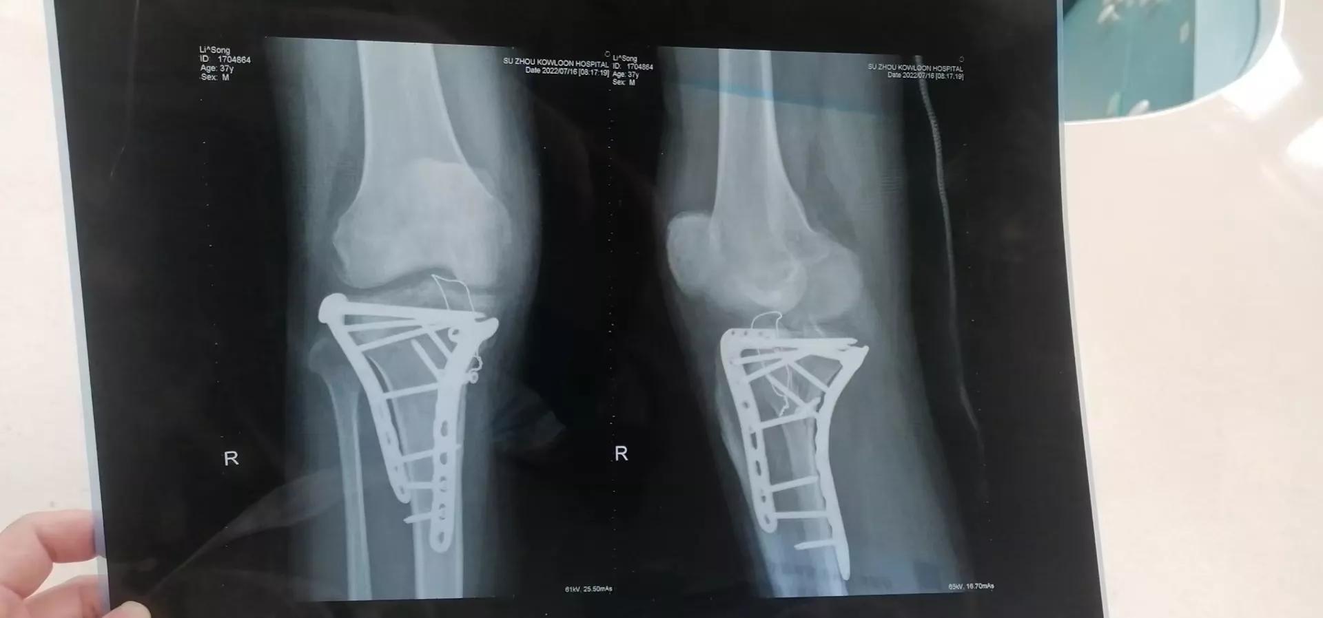 膝盖骨折不能弯曲最迟多久锻炼,骨折后膝盖僵硬无法弯曲怎么办