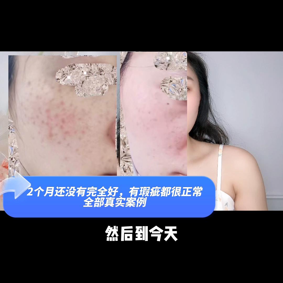 激光点痣掉痂后红印子可以护肤吗,点痣后的红印子可以正常护肤吗