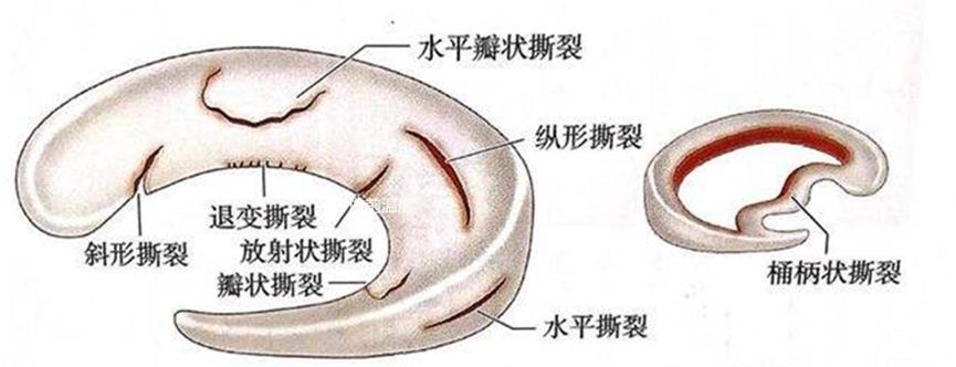 怎么预防半月板损伤,半月板损伤怎么预防最有效