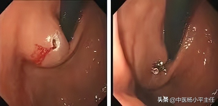 得胃肠息肉的几率有多大,中医如何认识肠道息肉原因