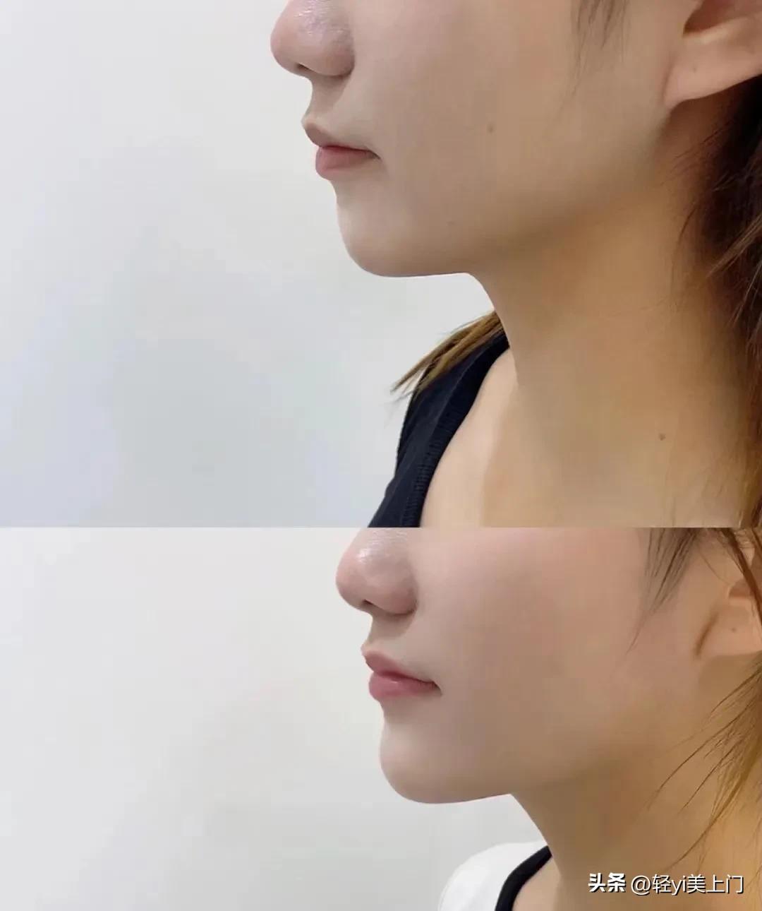 微整医美材料,医美微整注射图