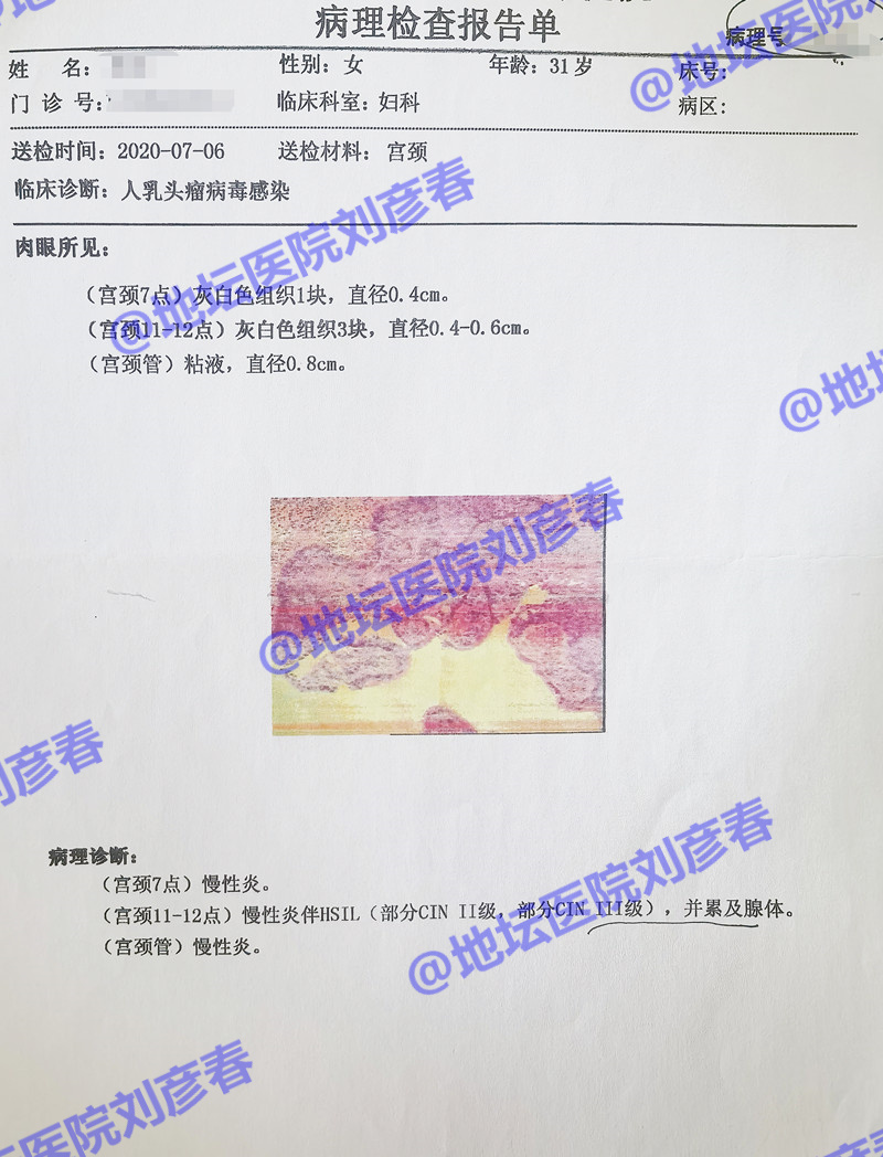 tct查出来中度炎症怎么治好,tct检查中度炎症如何用药