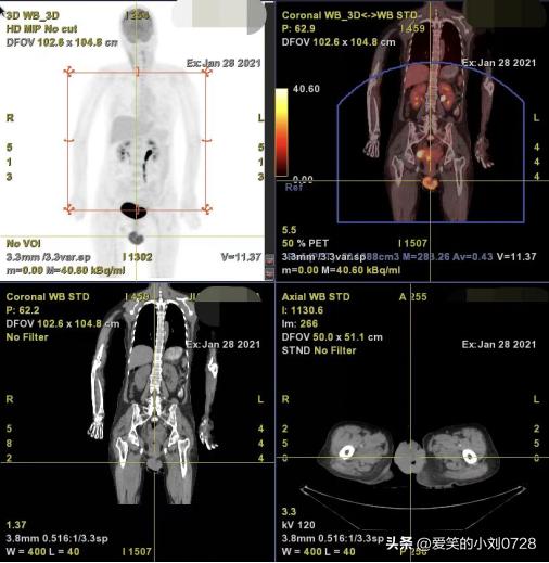 阿姨外阴长肿物，“绿豆”变“大枣”，外阴癌手术切除效果好