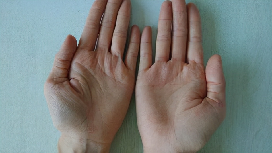 一级梅毒患者治疗后注意事项,和梅毒患者治疗期间接触