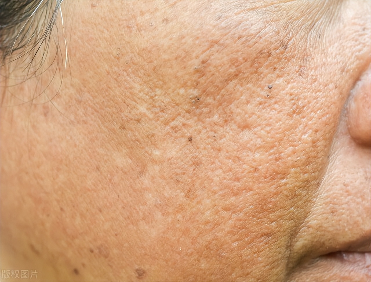 什么是顽固性雀斑,什么是雀斑跟晒斑