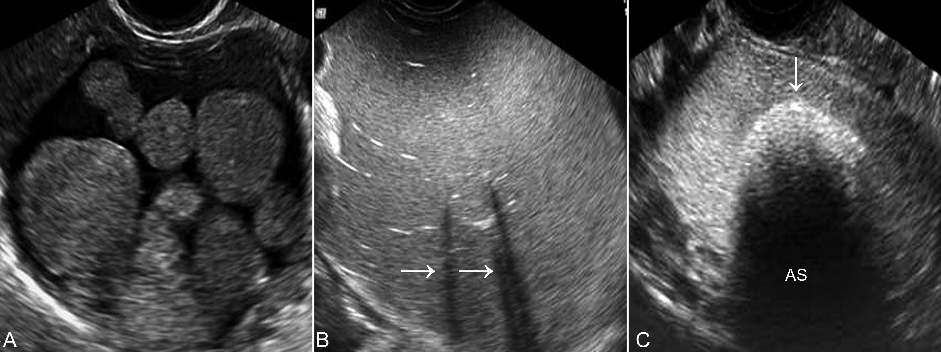 怀孕检查卵巢肿瘤良性恶性几率,妊娠合并卵巢肿瘤的鉴别诊断