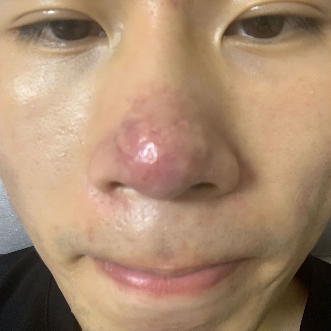 鼻子毛孔堵塞凸起有油脂粒,鼻子毛孔粗大有油脂粒怎么办