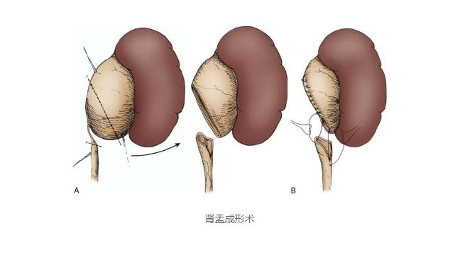 什么是肾积水?查出肾积水需要治疗吗?