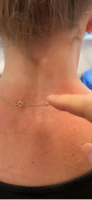 车祸留下后遗症头痛吃什么药有效,头痛后遗症最好的解决方法