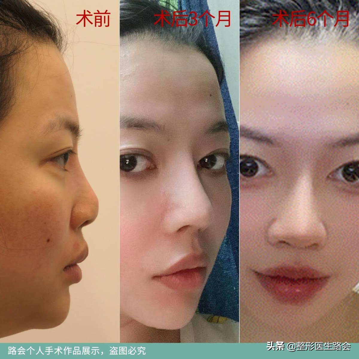 做膨体隆鼻感染了怎么办,膨体隆鼻注意事项