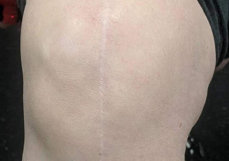 换了膝盖多长时间就不痛了,换了膝盖怎么康复