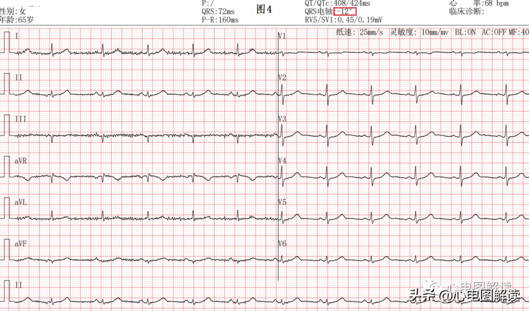 心电图会误诊冠心病吗,心电图会误诊心肌梗死吗