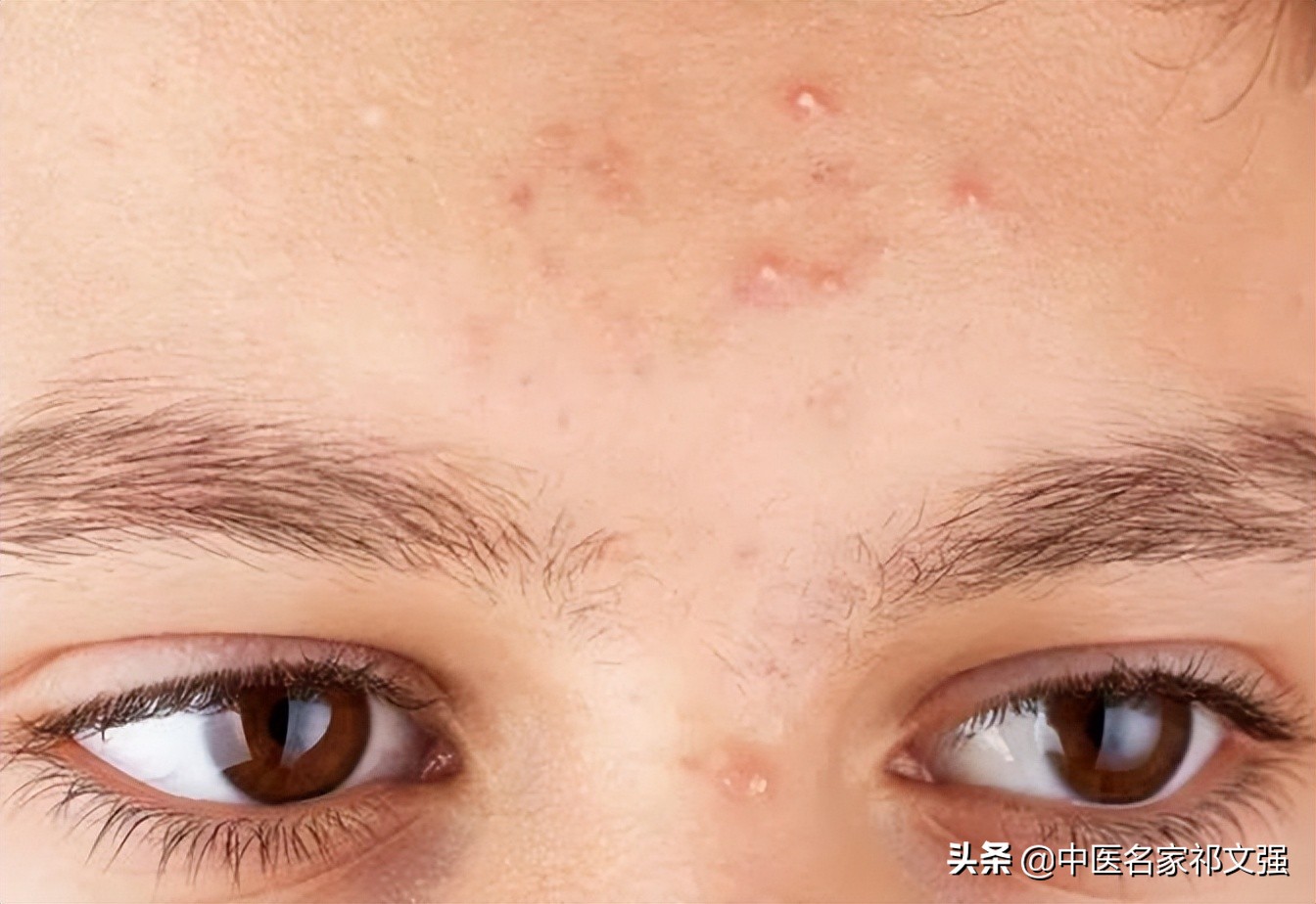 青少年痤疮最佳治疗药物,青少年痤疮用什么中药治疗