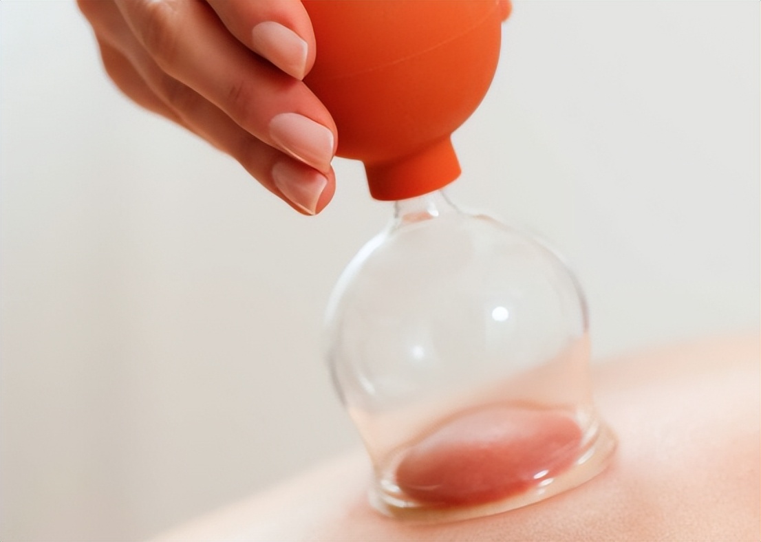 拔火罐吸出来的淤血，是体内的毒素？告诉你真相，看完涨知识