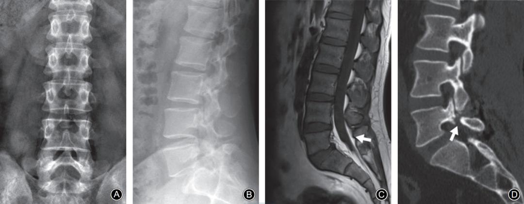 轻度峡部裂和重度峡部裂的区别,真性峡部裂和假性峡部裂