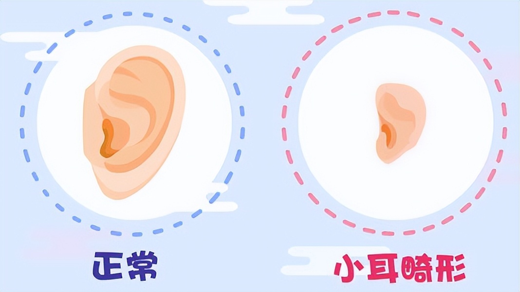 耳再造一期手术后起小疙瘩怎么治,小耳一期手术多久恢复