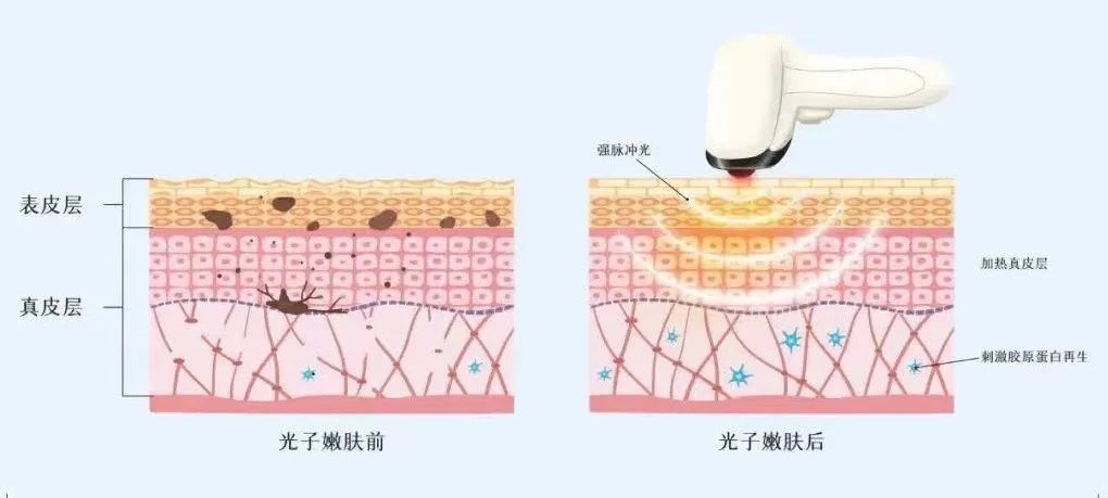 有效去黑眼圈和泪沟方法,黑眼圈泪沟抗衰老