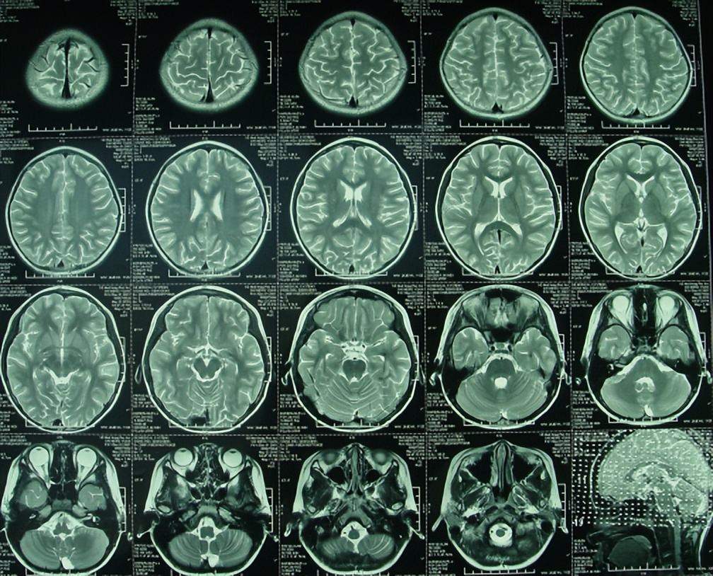 儿童结核脑膜炎脑积水,结核性脑膜炎脑积水如何引起