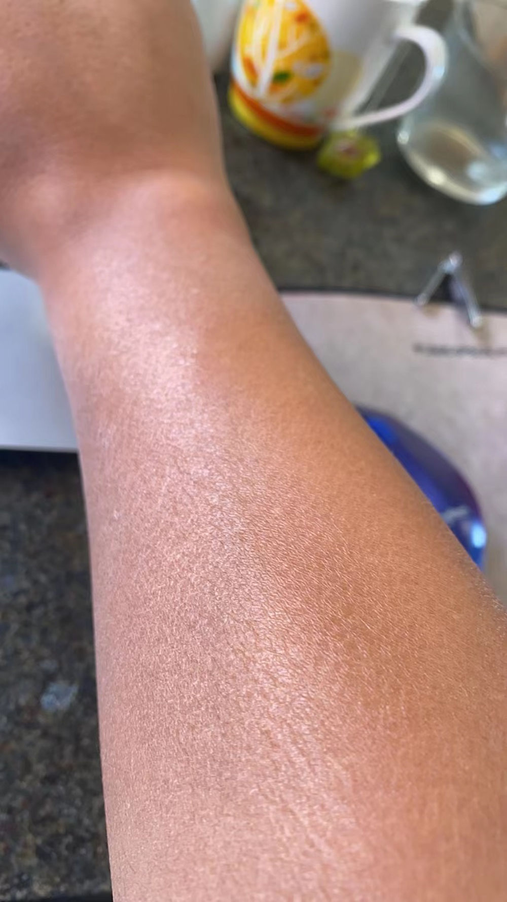 皮肤洗不干净老是脱皮,不洗澡身上晒得脱皮了怎么办